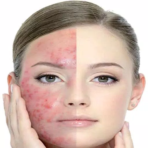 Get Rid of Acne  (Guide) Captura de tela 2